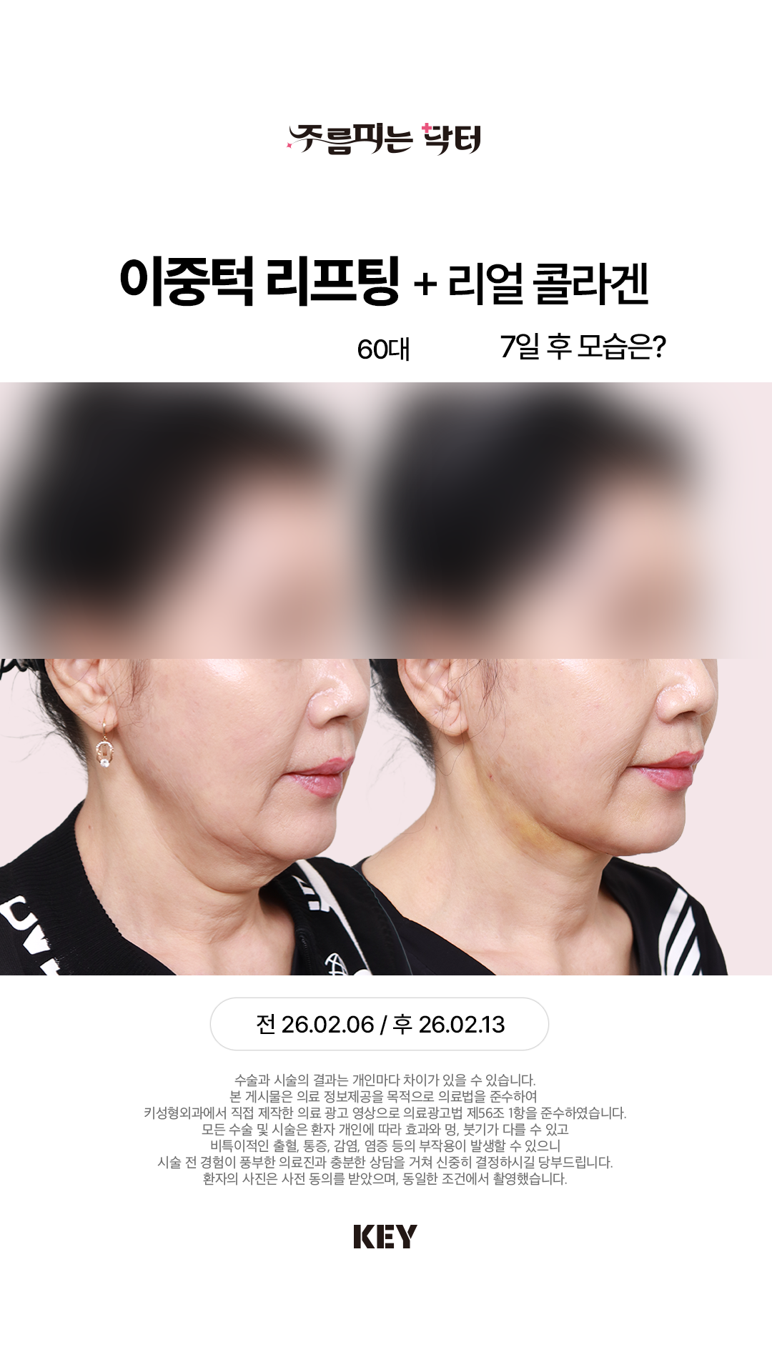 큰 수술은 무서운데 이중턱, 목이 고민이라면?