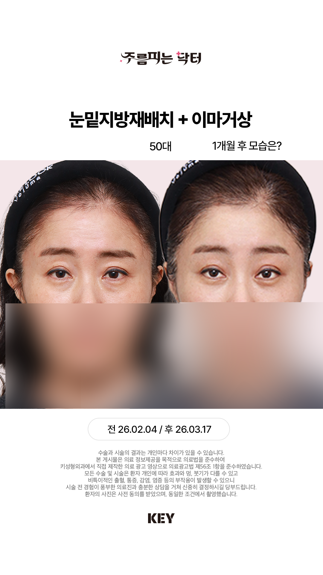 눈주변의 노화를 개선하는 리프팅
