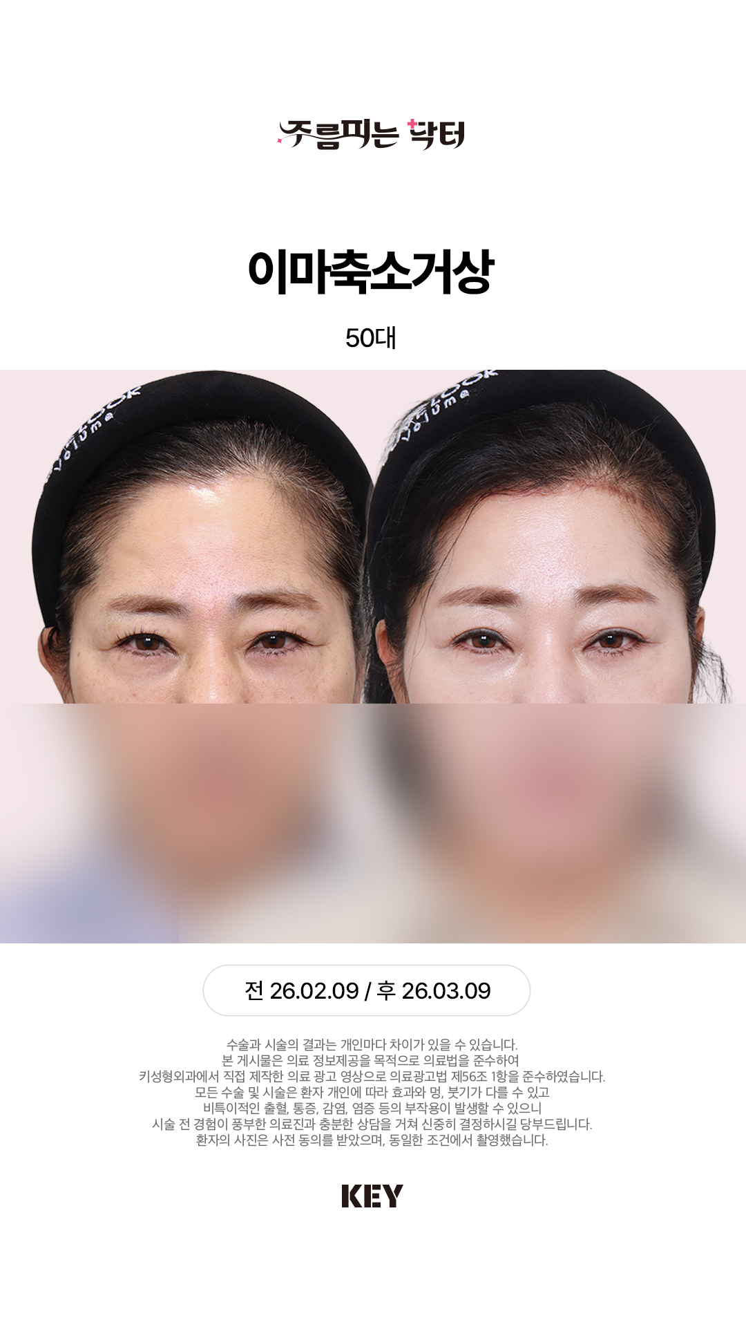 넓은이마, 처진눈이 고민이라면?