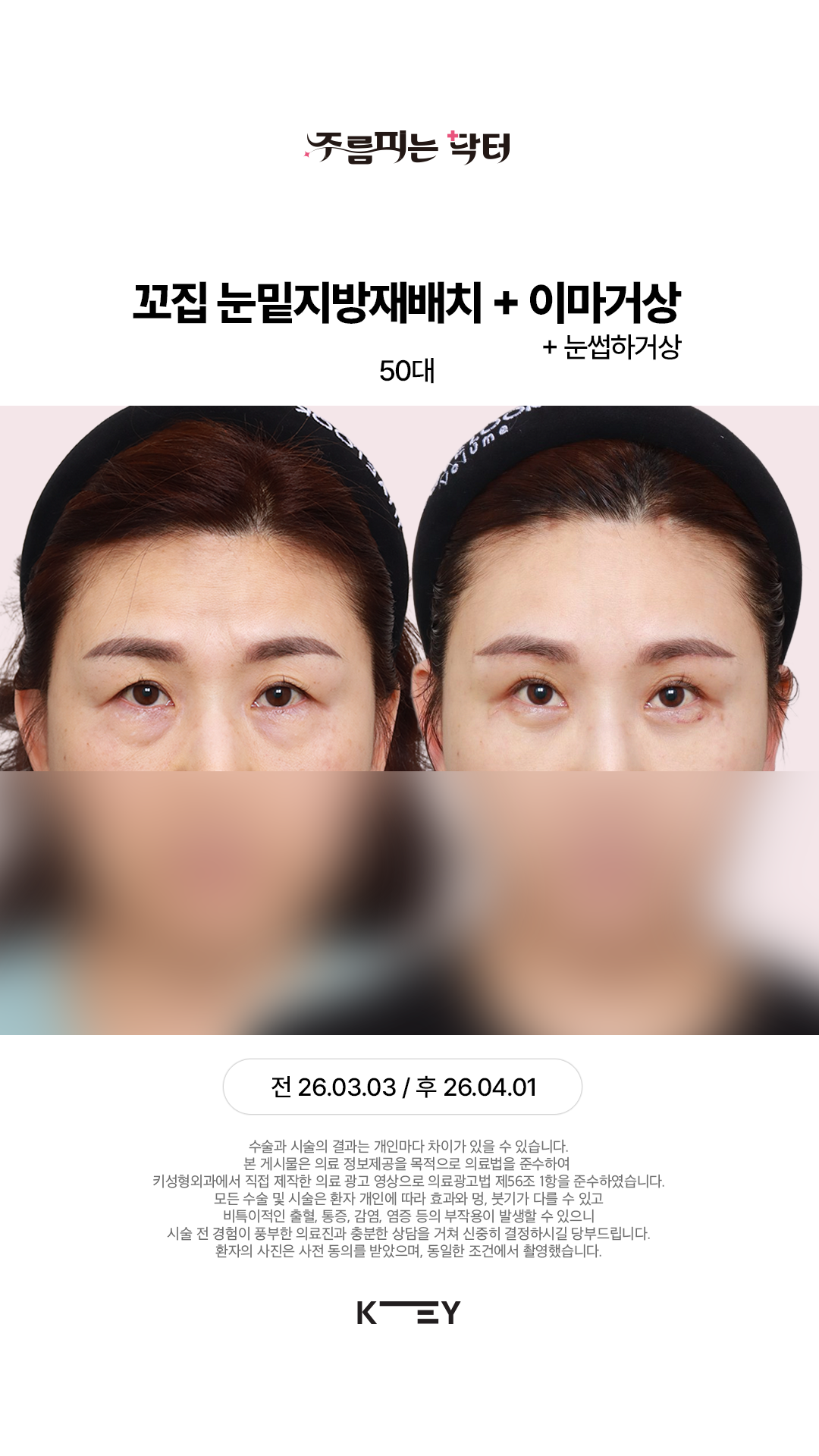 눈밑+눈꺼풀