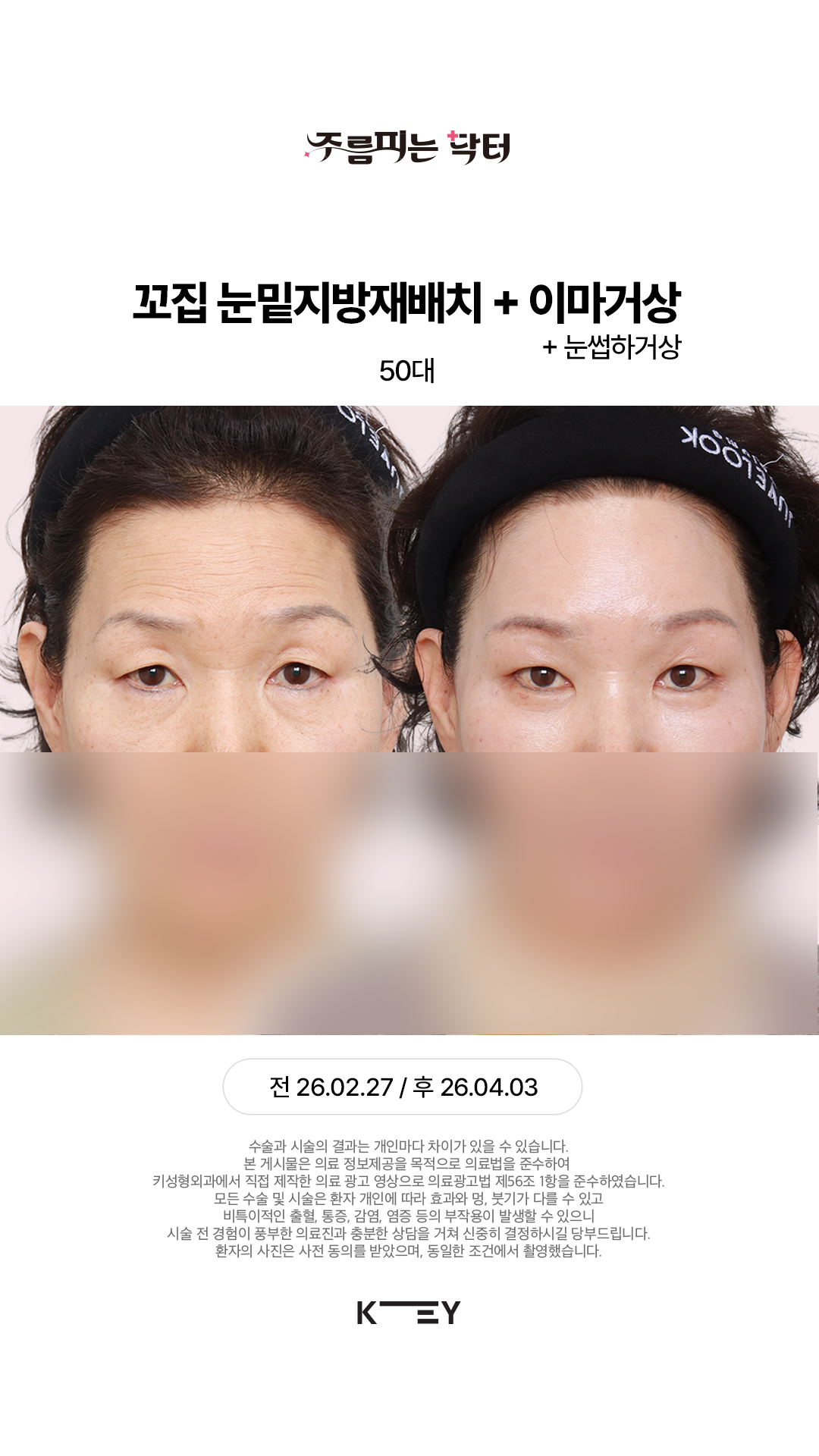 눈밑+눈꺼풀 리프팅