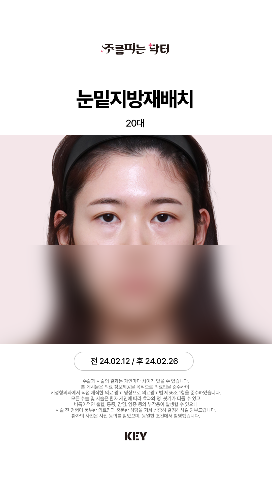 20대 여성 Before 1