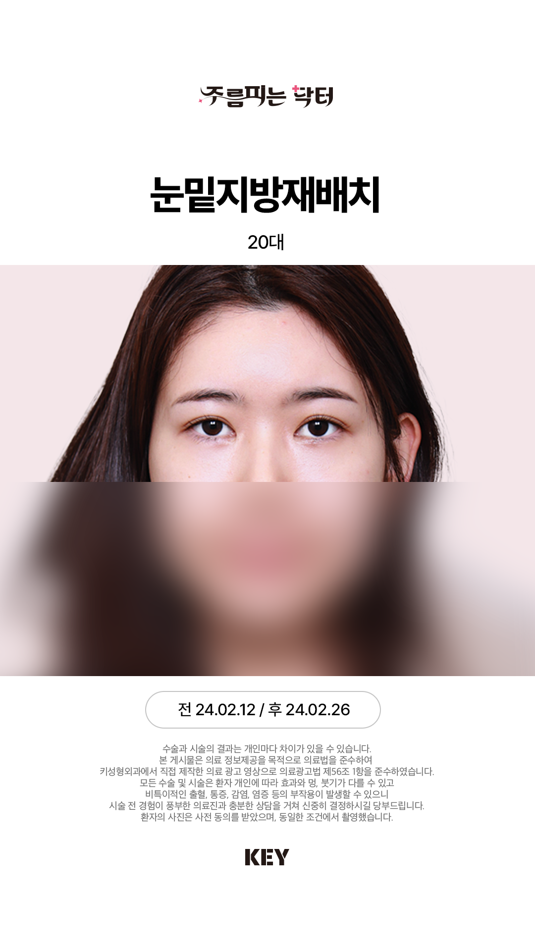 20대 여성 After 1
