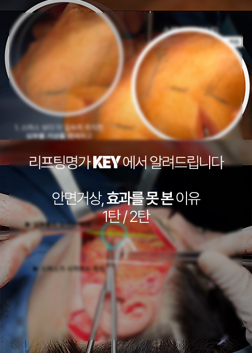 효과없는 안면거상의 이유